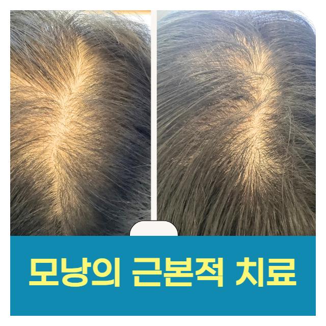모낭의 근본적 치료는 탈모치료전문 모가나의원에서