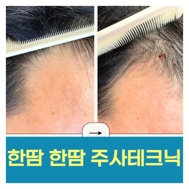 한땀 한땀 주사테크닉 탈모는 초기치료가 중요합니다!