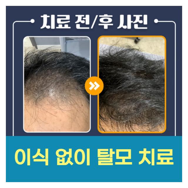 여성형 남성형 탈모 이식 없이 탈모치료하는 모가나의원